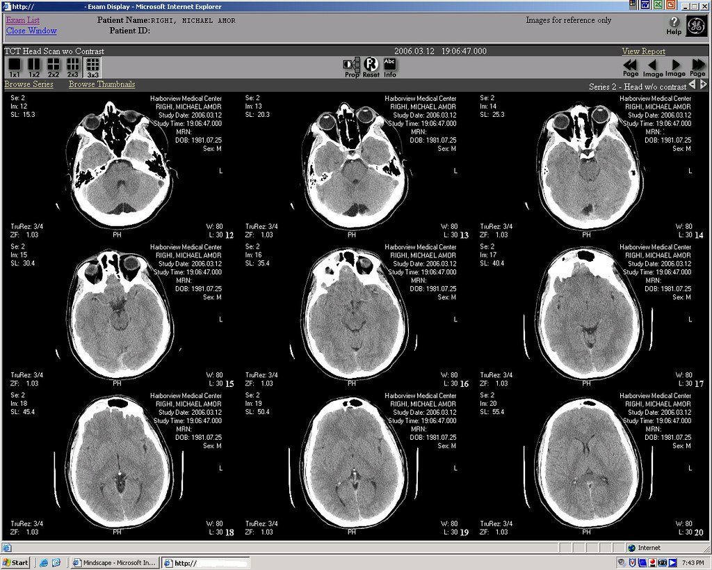 An AI Model Can Spot Pancreatic Cancer Three Years Before Doctors Can